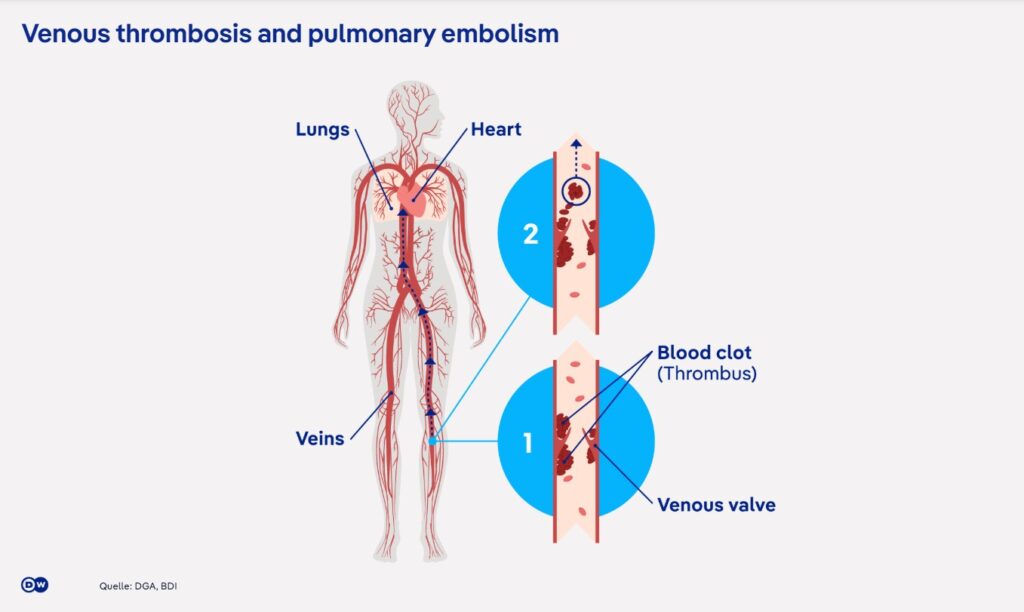 Thrombosis: a silent danger, even in sport