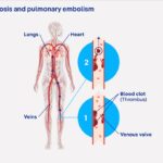 Thrombosis: a silent danger, even in sport