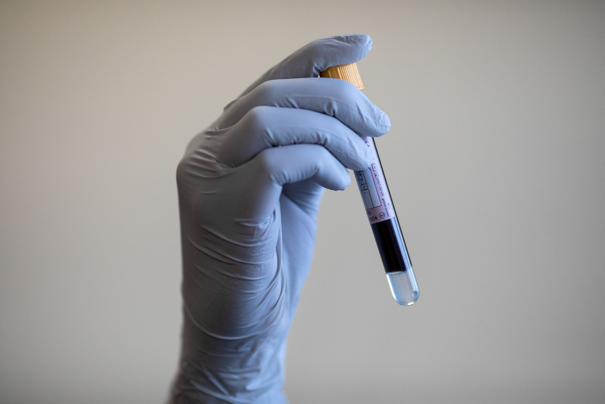 AI-enhanced blood tests could detect Parkinson's disease seven years ...