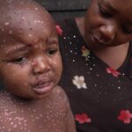 Mpox outbreak in DR Congo hits children hardest