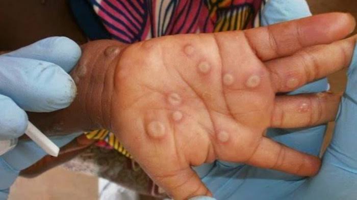 Africa Centres for Disease Control sounds alarm over mpox outbreak