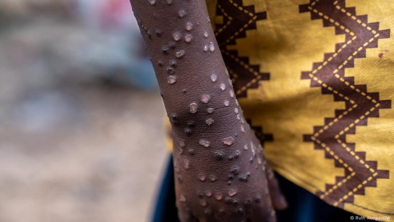 Can the spread of mpox be curbed