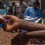 Mpox doses to start to arrive in Congo