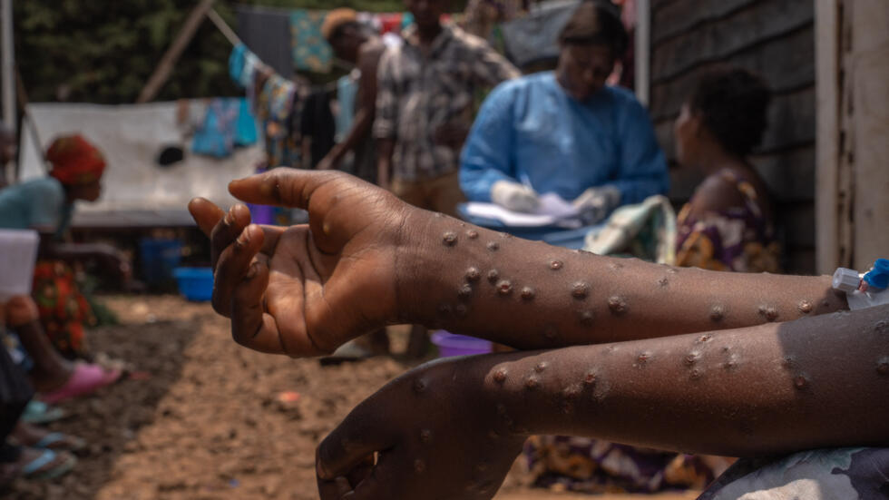 Mpox doses to start to arrive in Congo