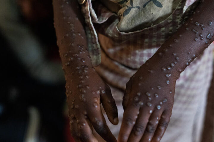 Fighting mpox stigma key to ending Burundi outbreak