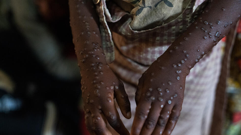 Fighting mpox stigma key to ending Burundi outbreak