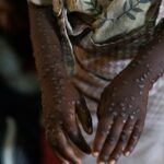 Mpox in Africa: Symptoms, stopping its spread and treatment