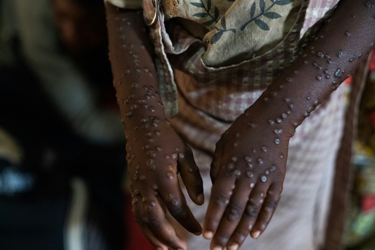 Mpox in Africa: Symptoms, stopping its spread and treatment