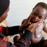 Mpox in Africa: Symptoms, stopping its spread and treatment