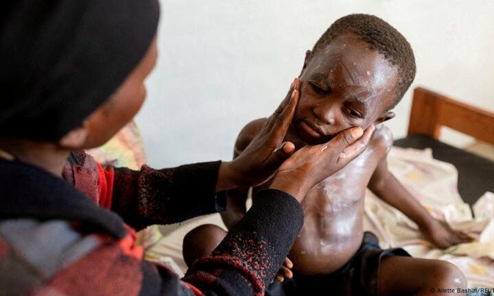 Mpox in Africa: Symptoms, stopping its spread and treatment