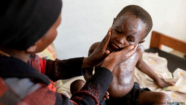 Mpox in Africa: Symptoms, stopping its spread and treatment