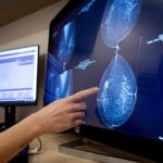 New AI method improves early breast cancer detection